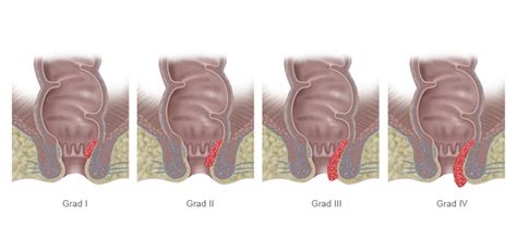 fotos reales de hemorroides|Bilder von Hämorrhoiden: Vier Schweregrade